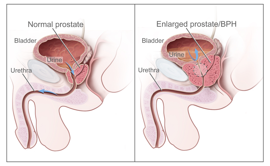 Comparison of normal prostate vs enlarged prostate